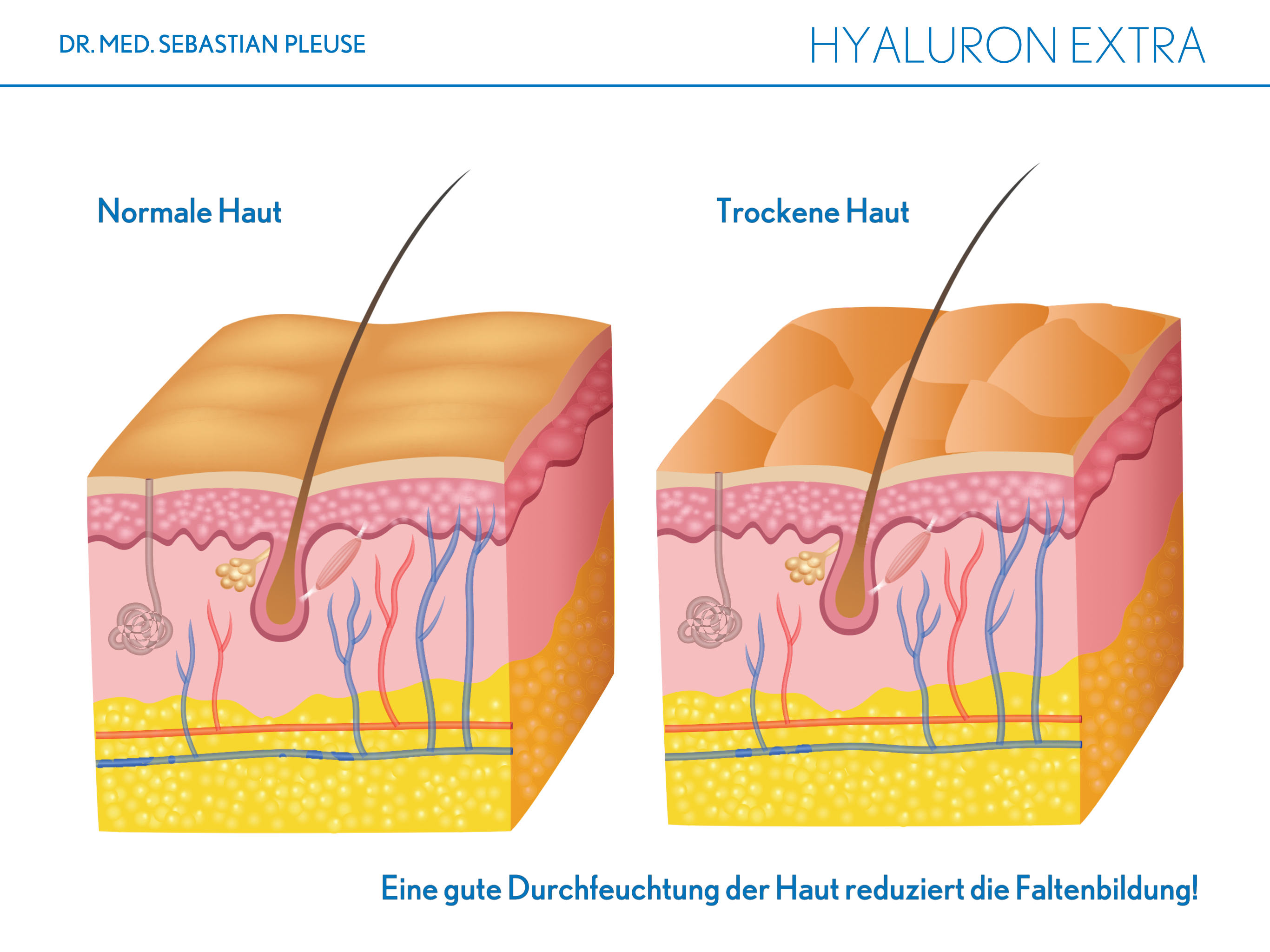 Hyaluron Extra (1 Monat)