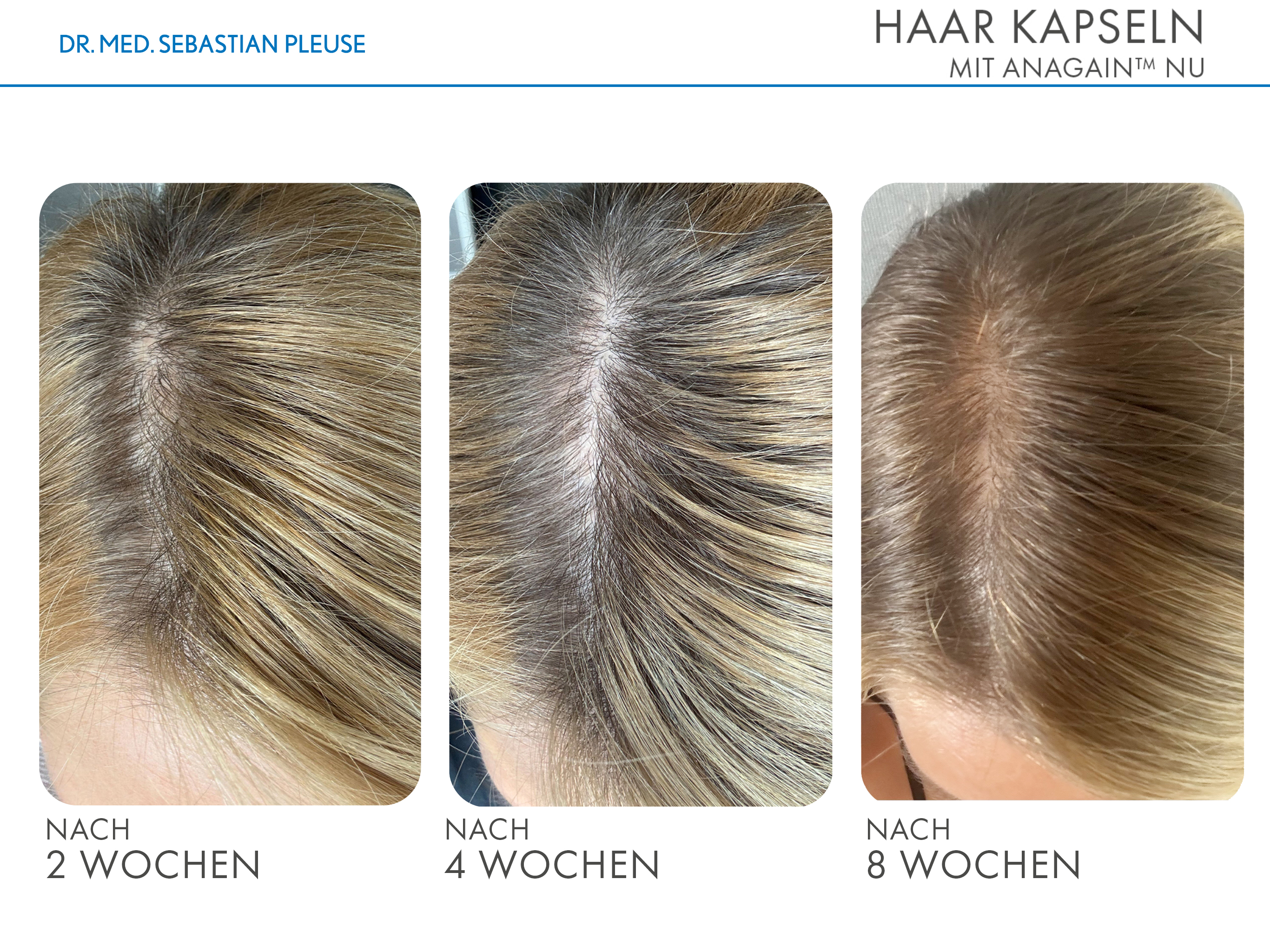 Haar Kapseln (1 Monat)