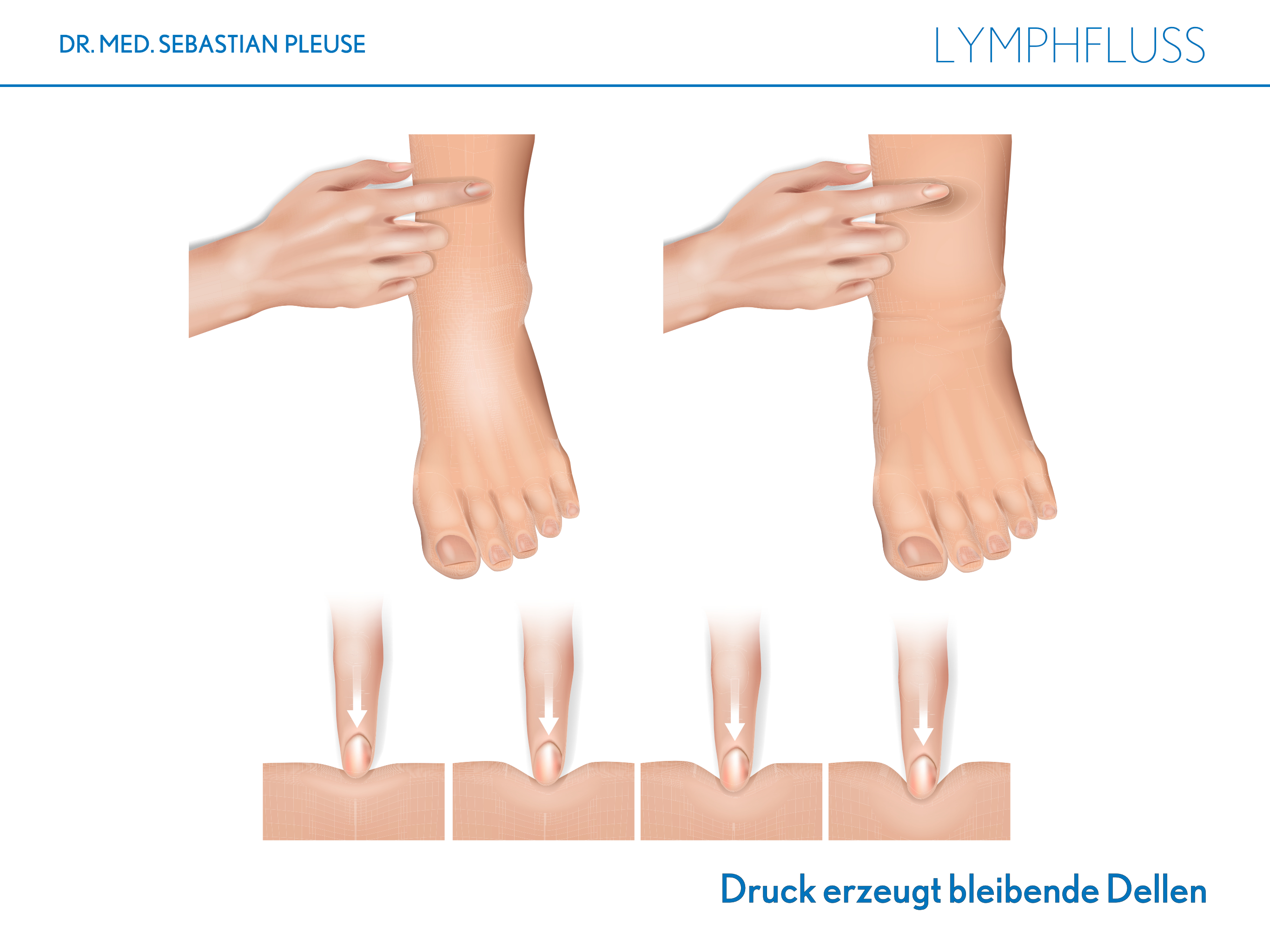 Lymphfluss (1 Monat)