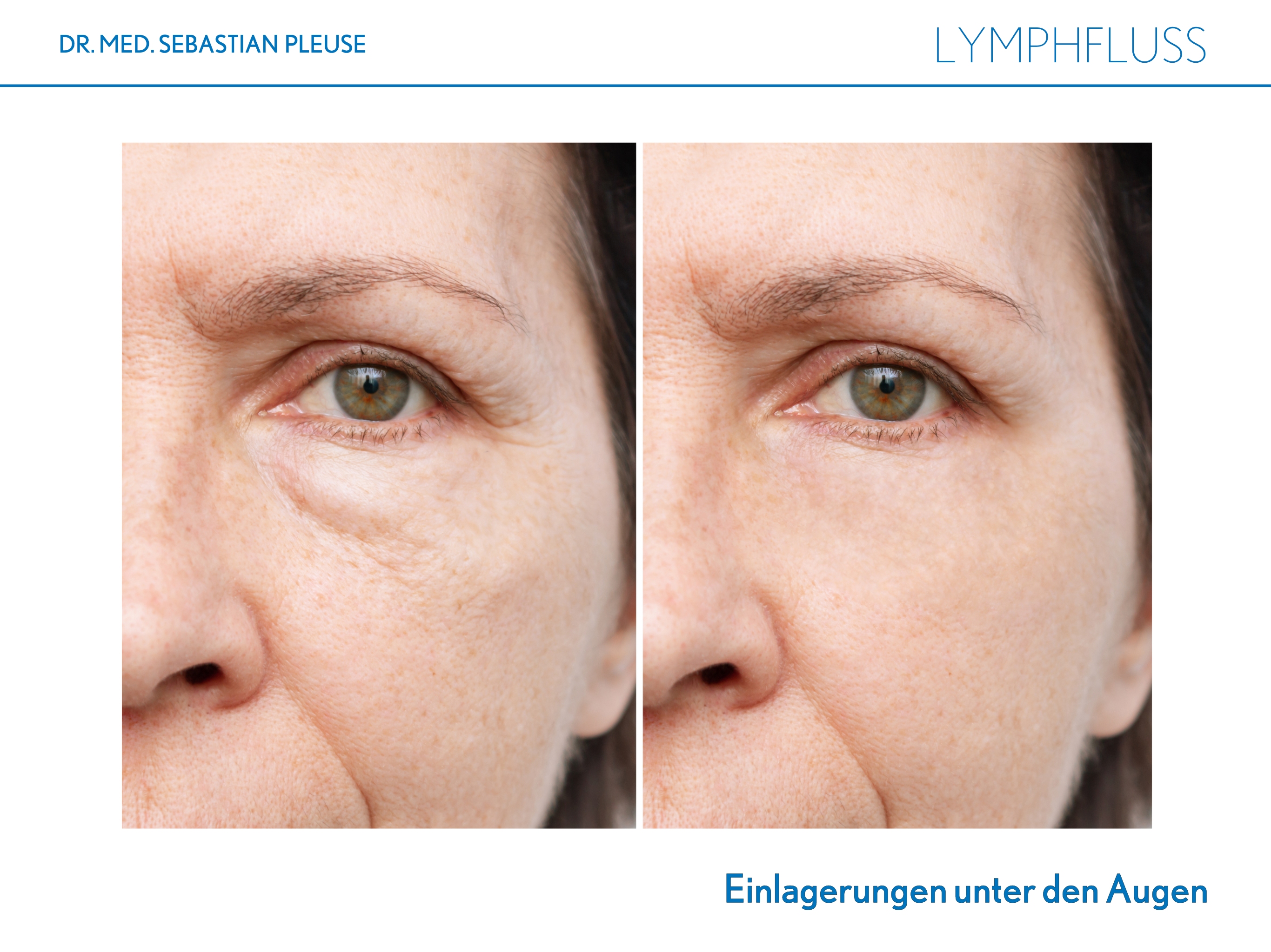 Lymphfluss (1 Monat)